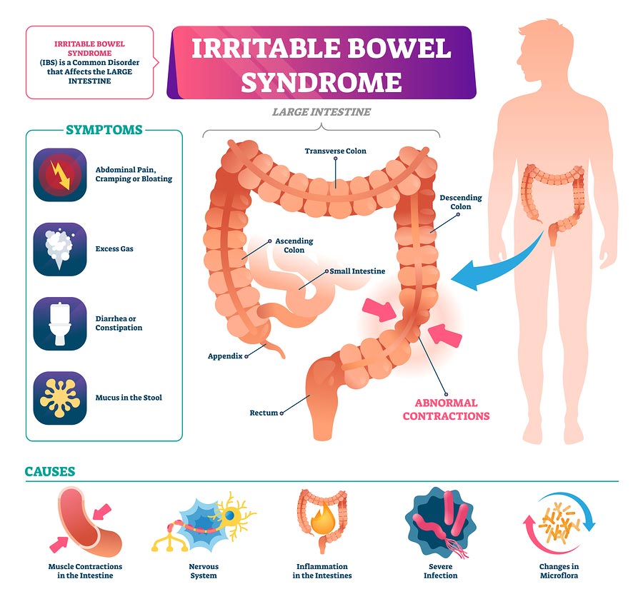 Diagram of irritable bowel syndrome symptoms and causes